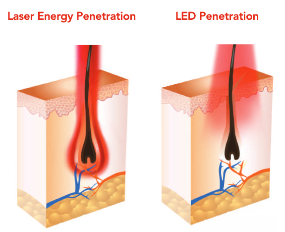 Laser Energy Penetration