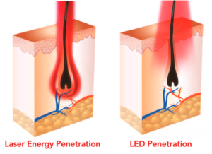 Laser Devices
